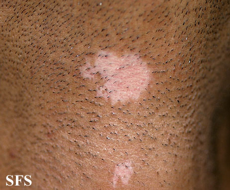 File:Vitiligo (Dermatology Atlas 29).jpg