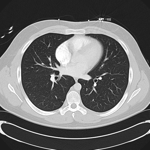 'Bovine' aortic arch (Radiopaedia 33554-34637 Axial lung window 34).png