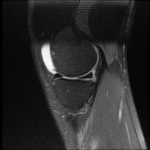 File:ACL acute full thickness tear - deep lateral femoral sulcus sign (Radiopaedia 38594-40740 Sagittal PD fat sat 5).jpg