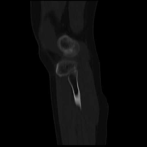 File:ACL avulsion fracture (Radiopaedia 33833-34994 Sagittal bone window 8).jpg