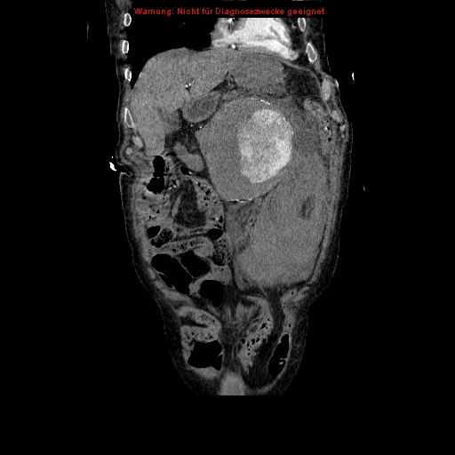 Abdominal aortic aneurysm- extremely large, ruptured (Radiopaedia 19882-19921 Coronal C+ arterial phase 29).jpg