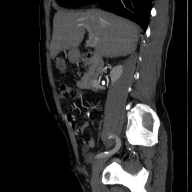 Abdominal aortic aneurysm (Radiopaedia 29248-29660 Sagittal C+ arterial phase 18).jpg