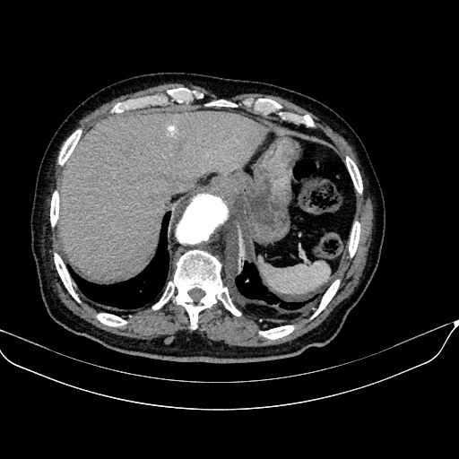 Abdominal aortic aneurysm (Radiopaedia 67117-76452 Axial C+ arterial phase 22).jpg