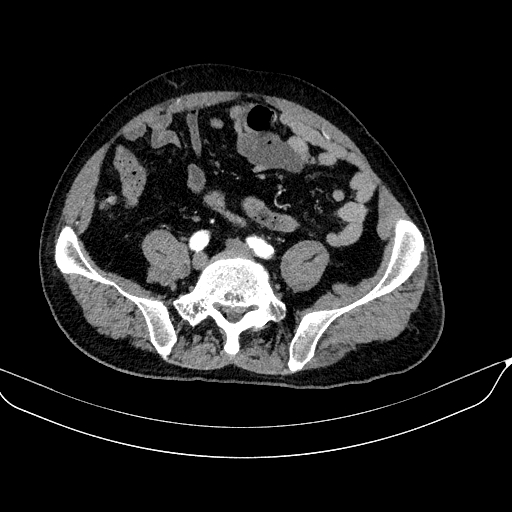 File:Abdominal aortic aneurysm (Radiopaedia 67117-76452 Axial C+ arterial phase 97).jpg