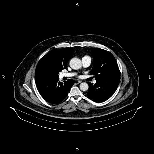 Abdominal aortic aneurysm (Radiopaedia 83094-97462 Axial renal cortical phase 39).jpg