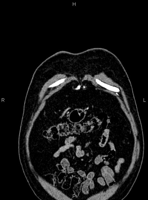 Abdominal aortic aneurysm (Radiopaedia 83094-97462 Coronal renal cortical phase 13).jpg