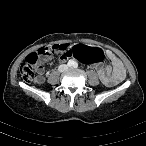 Abdominal aortic aneurysm (Radiopaedia 83581-98689 Axial C+ portal venous phase 70).jpg