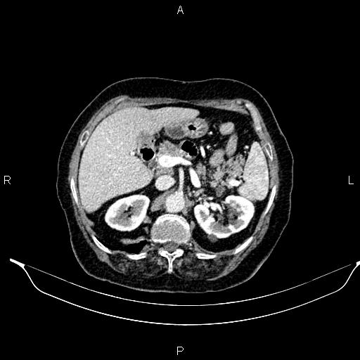 File:Abdominal aortic aneurysm (Radiopaedia 85063-100606 Axial C+ portal venous phase 34).jpg