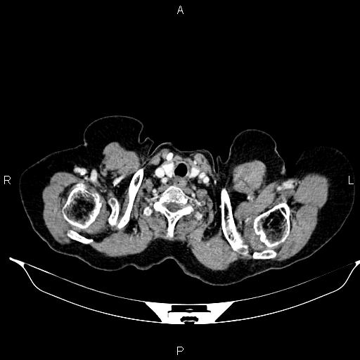 File:Abdominal aortic aneurysm (Radiopaedia 85063-100606 Axial C+ portal venous phase 4).jpg