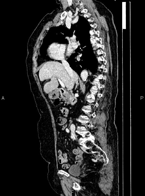 Abdominal aortic aneurysm (Radiopaedia 85063-100606 Sagittal C+ arterial phase 32).jpg