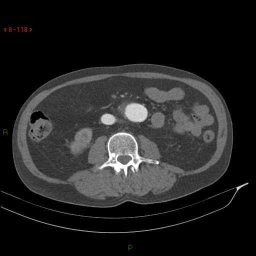 Abdominal aortic aneurysm rupture with aortocaval fistula (Radiopaedia 14897-14841 Axial C+ arterial phase 118).jpg
