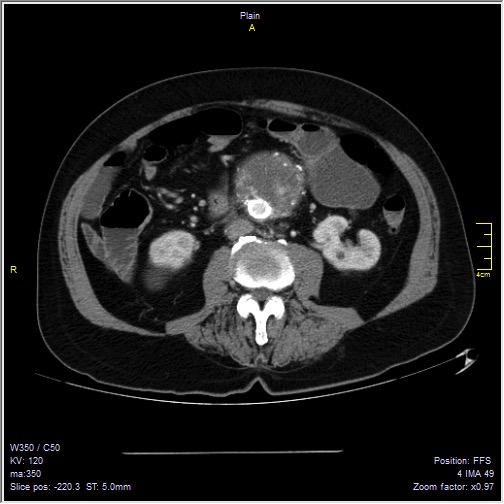 Abdominal aortic aneurysm with thrombus fissuration (Radiopaedia 47340-51926 Axial C+ arterial phase 33).jpg