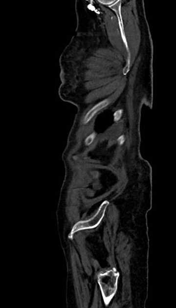 Abdominal aortic aneurysm with thrombus fissuration (Radiopaedia 73192-83919 Sagittal C+ arterial phase 3).jpg