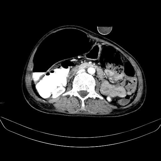 File:Abdominal collection due to previous cecal perforation (Radiopaedia 80831-94320 Axial C+ portal venous phase 99).jpg