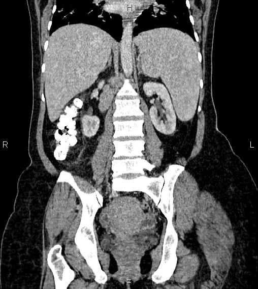 File:Abdominal lymphoma with sandwich sign (Radiopaedia 84378-99704 Coronal C+ portal venous phase 42).jpg