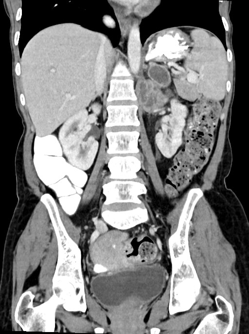 Abdominal wall and retroperitoneal tuberculosis (Radiopaedia 88137-104729 Coronal C+ portal venous phase 61).jpg