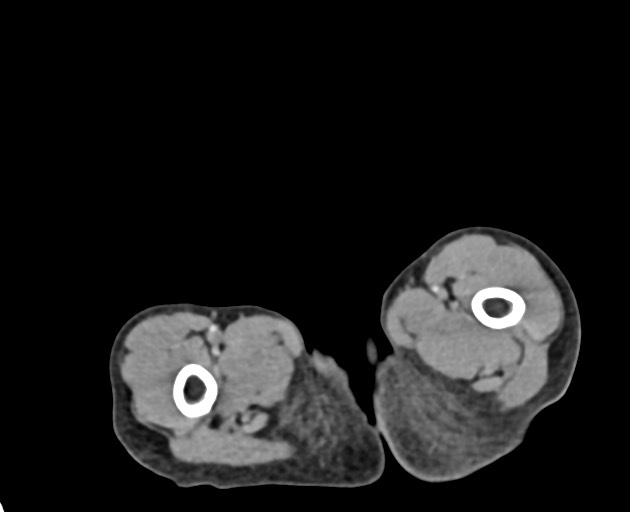 Abdominopelvic rhabdomyosarcoma (Radiopaedia 78356-90984 Axial C+ portal venous phase 171).jpg