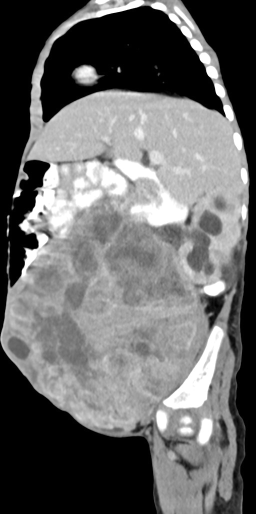 Abdominopelvic rhabdomyosarcoma (Radiopaedia 78356-90984 Sagittal C+ portal venous phase 65).jpg