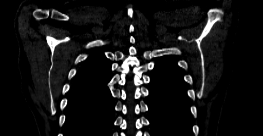 Accesory rib joint (Radiopaedia 71987-82452 Coronal bone window 63).jpg