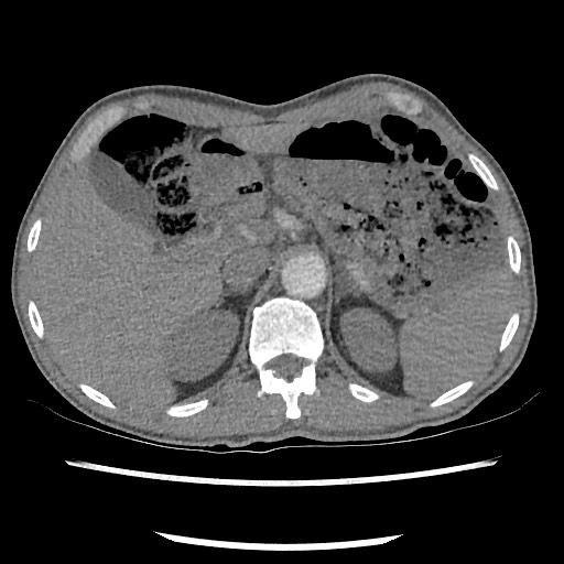 File:Accessory left horizontal fissure with lingular pneumonia (Radiopaedia 53763-59843 Axial C+ CTPA 90).jpg