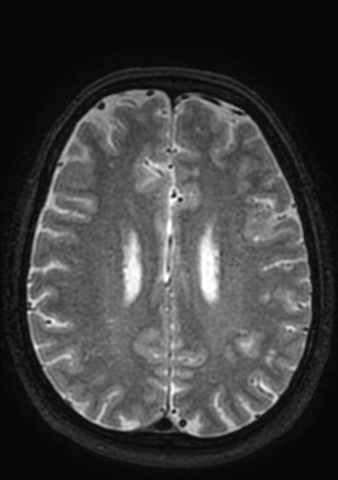 Accessory middle cerebral artery (Radiopaedia 73114-83828 Axial T2 13).jpg