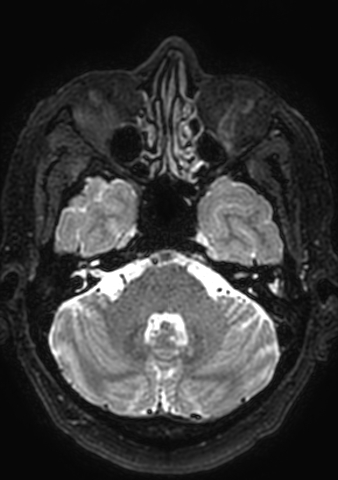 File:Accessory middle cerebral artery (Radiopaedia 73114-83828 Axial T2 162).jpg