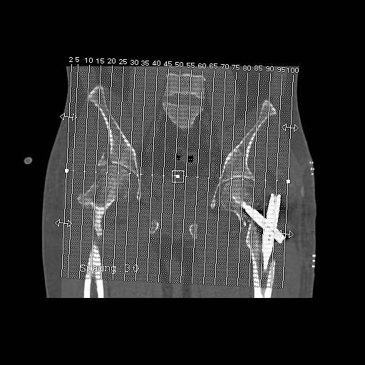 Acetabular and ilial fractures (Radiopaedia 59084-66378 Sagittal bone window 1).jpg