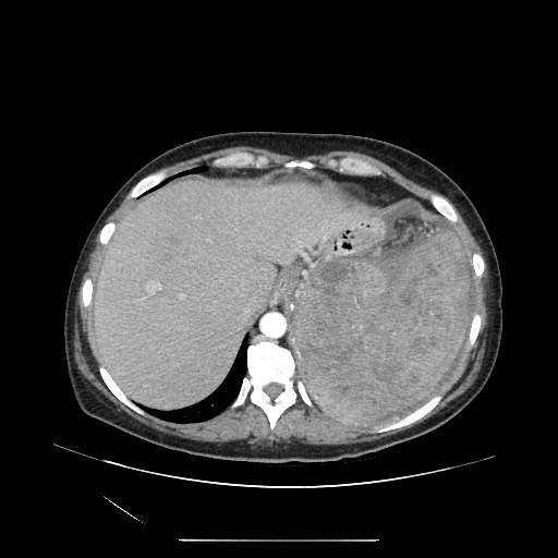 Acinar cell carcinoma of the pancreas (Radiopaedia 75442-86669 Axial C+ portal venous phase 21).jpg