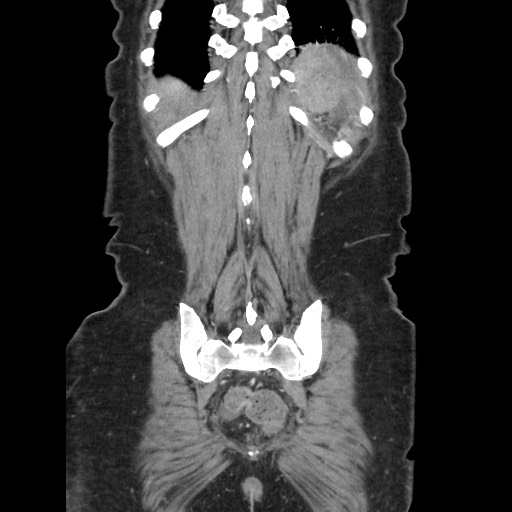 Acinar cell carcinoma of the pancreas (Radiopaedia 75442-86669 Coronal C+ portal venous phase 109).jpg