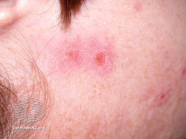File:Acne excorie (DermNet NZ acne-acne-excorie2).jpg