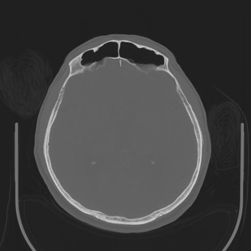 File:Acoustic schwannoma (Radiopaedia 29488-29982 AXIAL BONE THICK non-contrast 25).jpg