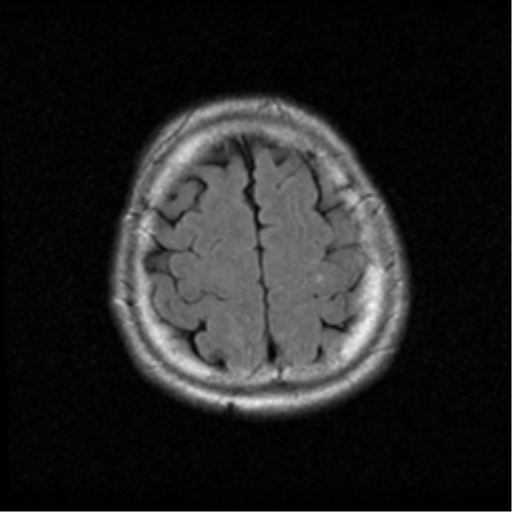 File:Acoustic schwannoma (Radiopaedia 39170-41387 Axial FLAIR 19).png