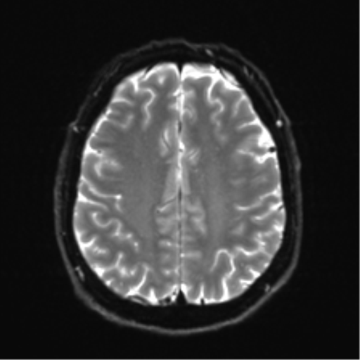 File:Acoustic schwannoma (Radiopaedia 50846-56358 Axial DWI 22).png