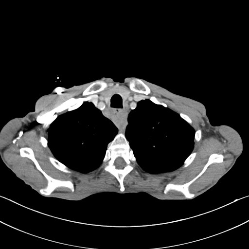 File:Acquired tracheoesophageal fistula (Radiopaedia 57747-65042 Axial C+ portal venous phase 16).jpg