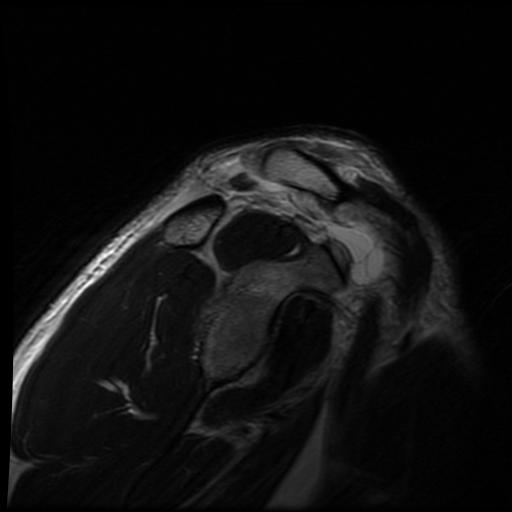 File:Acromioclavicular joint dislocation (Radiopaedia 14218-14076 Sagittal T2 10).jpg