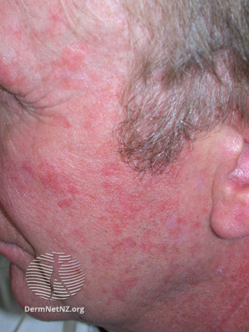 Actinic Keratoses affecting the face (DermNet NZ lesions-ak-face-379).jpg