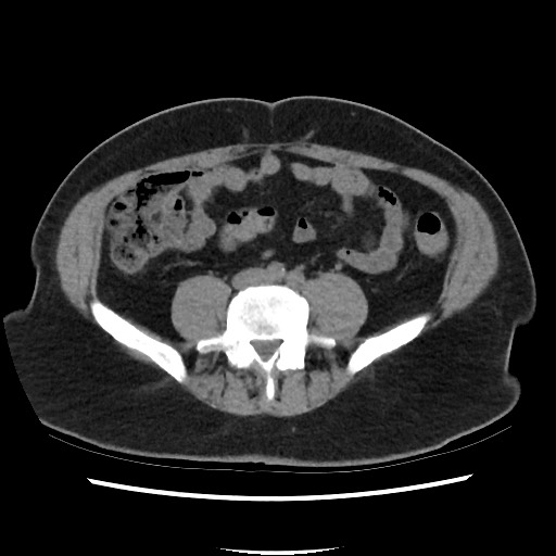 File:Active colonic bleed on CT (Radiopaedia 49765-55025 Axial non-contrast 53).jpg