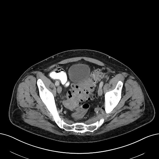 File:Active lower gastrointestinal bleeding - diverticular (Radiopaedia 61203-69106 Axial C+ portal venous phase 107).jpg