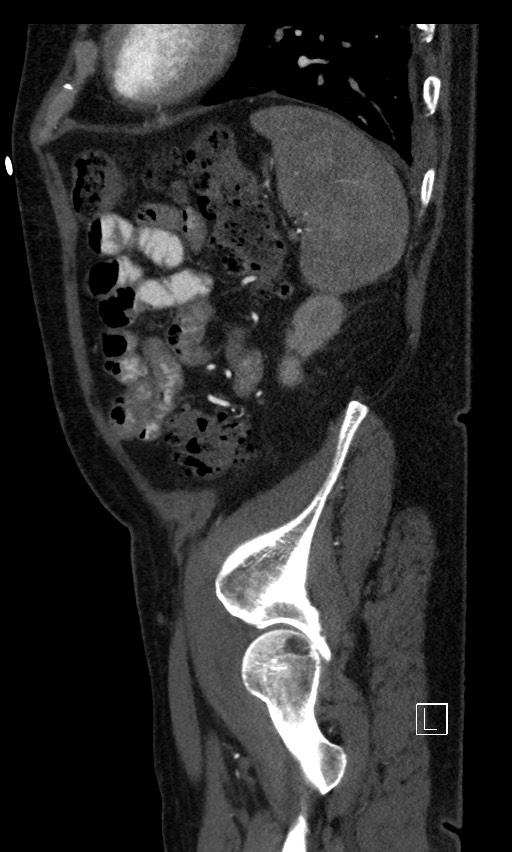 Active lower gastrointestinal bleeding - diverticular (Radiopaedia 61203-69106 Sagittal C+ arterial phase 31).jpg