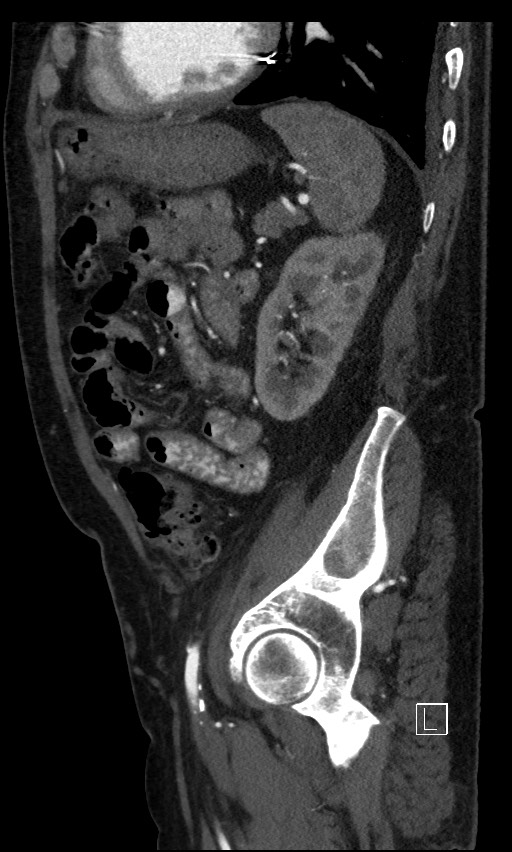 Active lower gastrointestinal bleeding - diverticular (Radiopaedia 61203-69106 Sagittal C+ arterial phase 45).jpg