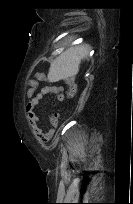 Active renal extravasation with large subcapsular and retroperitoneal hemorrhage (Radiopaedia 60975-68796 Sagittal C+ portal venous phase 184).jpg