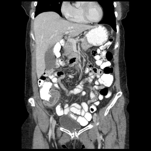 Acute appendicitis (Radiopaedia 52672-58589 Coronal C+ portal venous phase 27).jpg