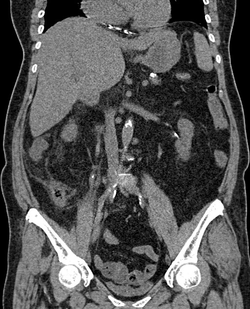 Acute appendicitis (Radiopaedia 58627-65818 Coronal non-contrast 40).jpg