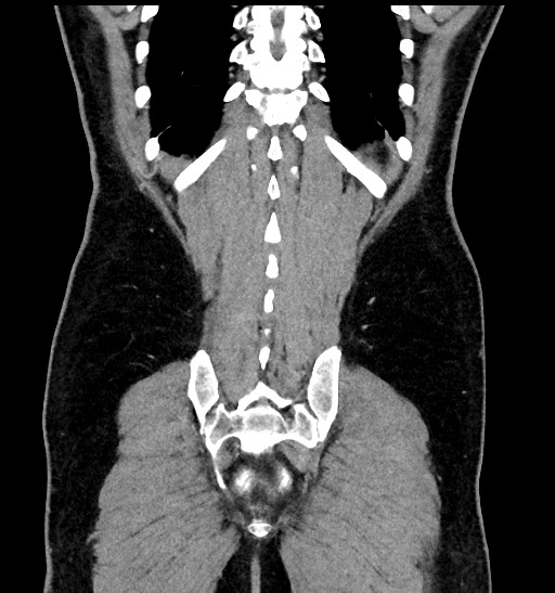 Acute appendicitis (Radiopaedia 77016-88960 Coronal C+ portal venous phase 83).jpg