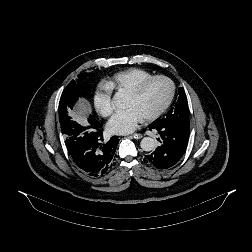 File:Acute appendicitis (Radiopaedia 79950-93224 Axial C+ portal venous phase 4).jpg