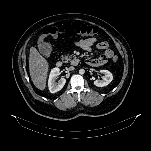 Acute appendicitis (Radiopaedia 79950-93224 Axial C+ portal venous phase 44).jpg