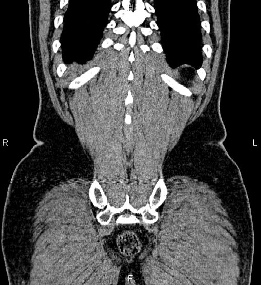 Acute appendicitis (Radiopaedia 84780-100240 Coronal C+ portal venous phase 75).jpg