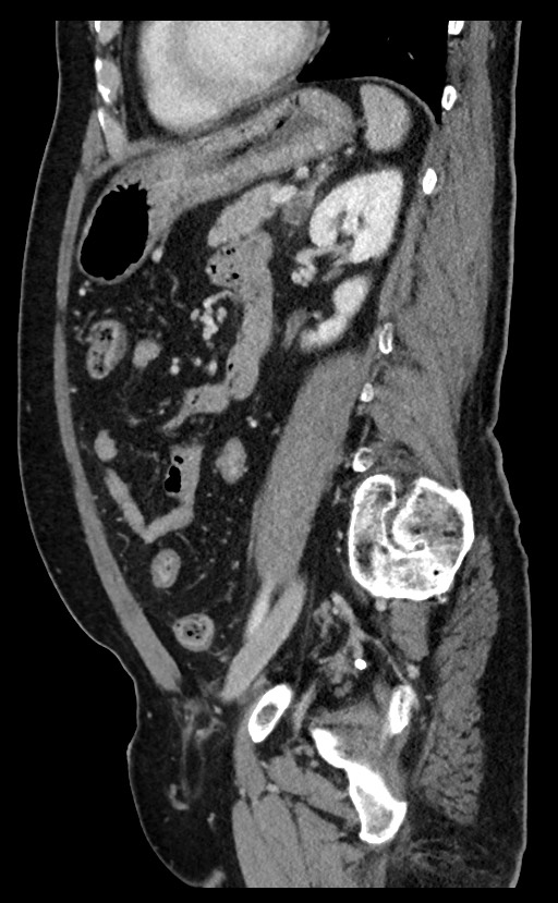 Acute appendicitis - large appendicoliths (Radiopaedia 61805-69820 Sagittal C+ portal venous phase 41).jpg