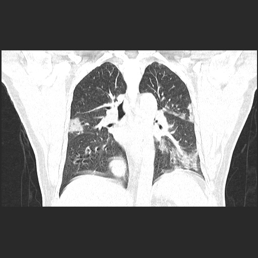 File:Acute appendicitis and COVID 19 pneumonia (Radiopaedia 76604-88380 G 39).jpg