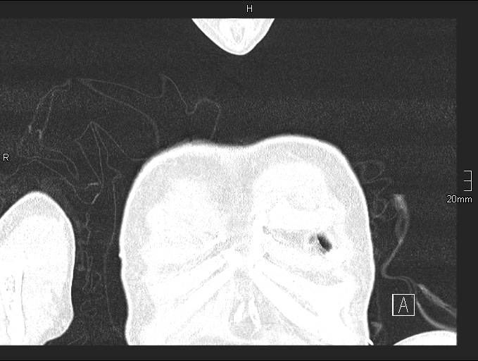 Acute aspiration pneumonitis (Radiopaedia 55642-62166 Coronal lung window 3).jpg